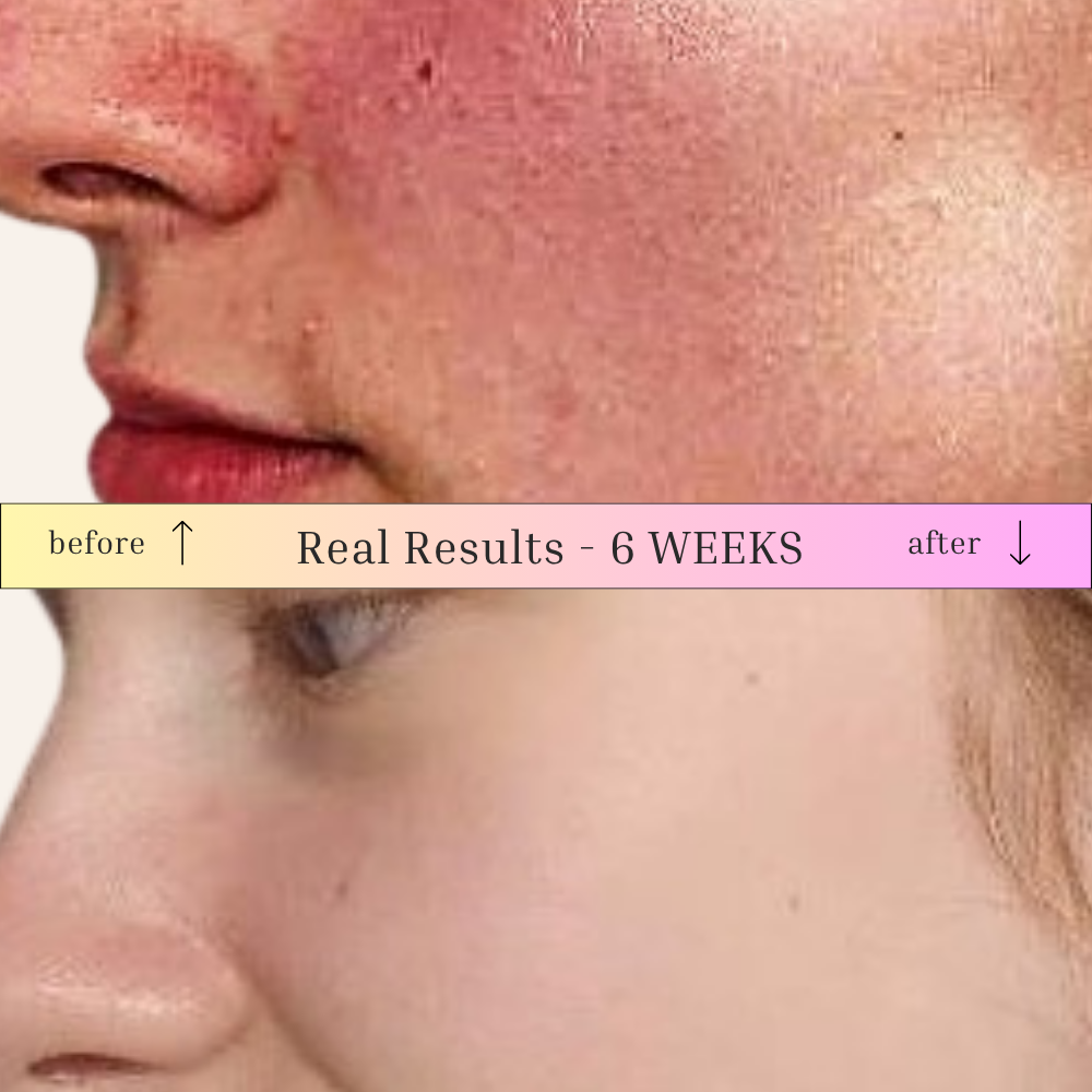 Acne Rescue & Balance Bundle